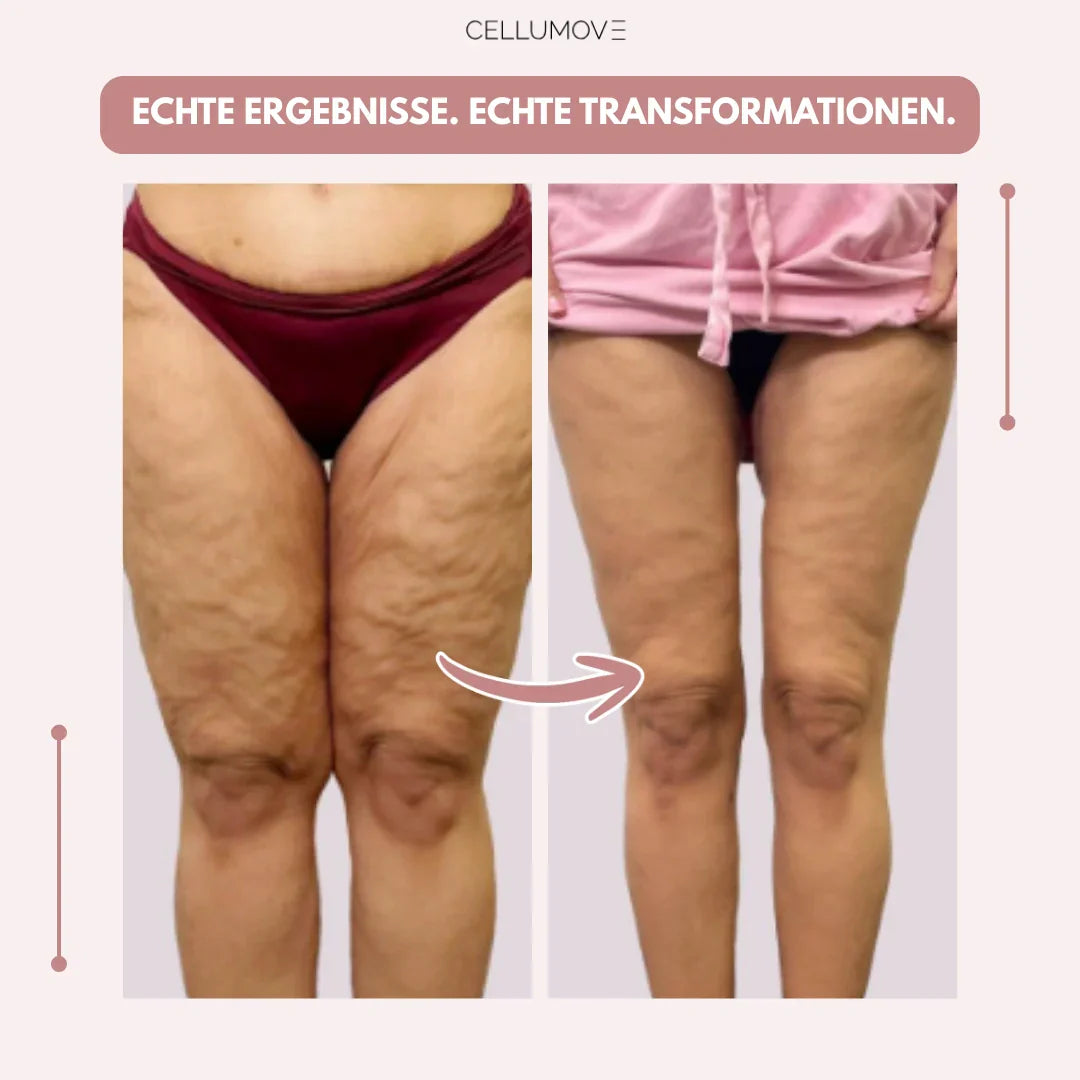 Cellumove 3D Legging – Verabschieden Sie sich auf natürliche Weise von den Schmerzen und Schwellungen des Lipödems